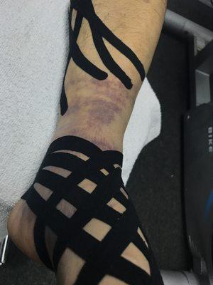 Kinesio taping technique to decrease swelling.