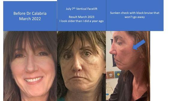 Vertical facelift.  Lots of loose skin. Sunken cheek with black bruise. Renato Calabria, Plastic Surgeon, Beverly Hills CA  patient results