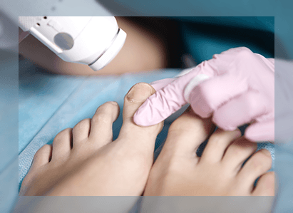 Laser Treatment for Onychomycosis (Nail Fungus)