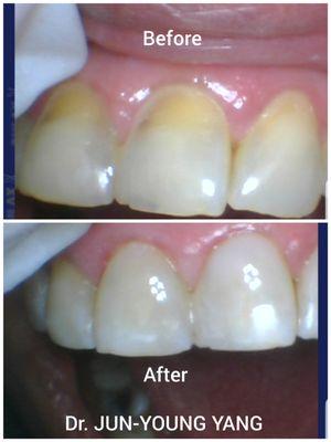 Beautiful makeover by Dr. YANG at Cal Dental Anaheim!