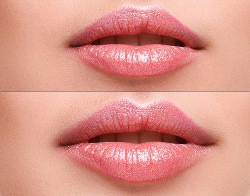 Lip Augmentation Before and After