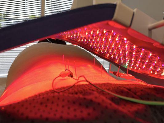 Acupuncture with Near-infrared LED Phototherapy and Electroacupuncture for Pain, Inflammation