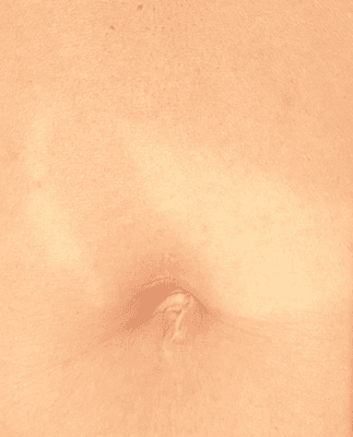 Tiny incision that Dr. B made when shrinking my fibroid.  Cannot even tell I had surgery here!