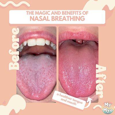 Nasal breathing keeps the mouth moist, healthy and prevents bad bacterial growth (cavities)! Early intervention is crucial!