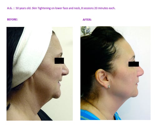 Face tightening and jowl reduction with Radio Frequency.