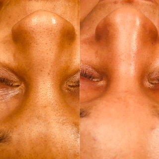 Before And after Dermaplaning Facial.