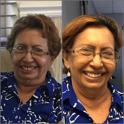 My grandma  before and After! One day visit they did her  smile used crowns in their in-house lab