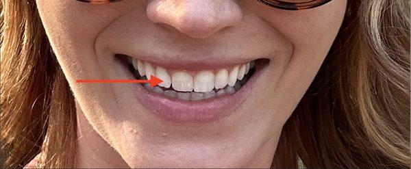 See the difference between the density of my teeth near the gum & the translucency towards the tip? This is dehydration from Invisalign.