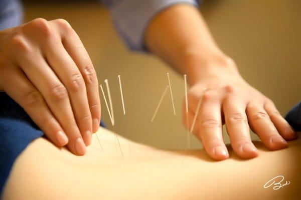 Back Pain Acupuncture