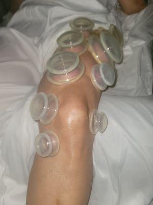 Neuromuscular Cupping