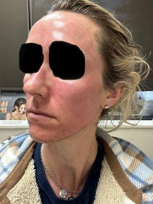 Moments after PRP after Microneedling. Minimal downtime, awesome results!