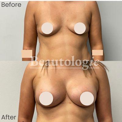 Bilateral Breast Augmentation with 425ml Silicone Implants Before and After