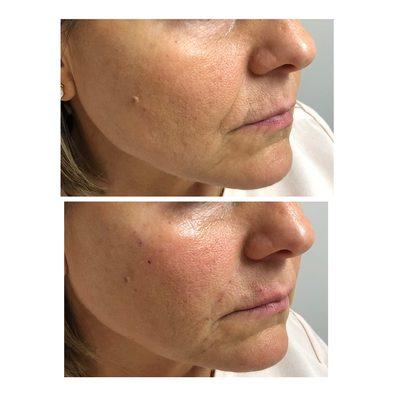 Nasolabial Folds & Marionette line correction with JUVEDERM Ultra plus