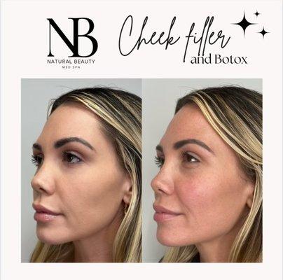 Cheek filler is great for those looking to add definition and volume to their face!