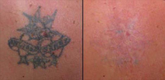 Laser Tattoo Removal NYC - Before & After