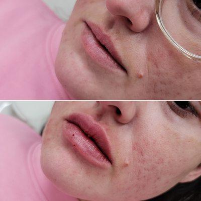 Beautiful full, hydrated lips after being treated with 1cc of Juvederm