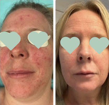 2 treatments for redness/rosacea/laxity/sun damage and one laser resurfacing treatment. These results were accomplished in 4 months.