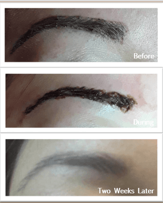 Microblading Removal and Lightening