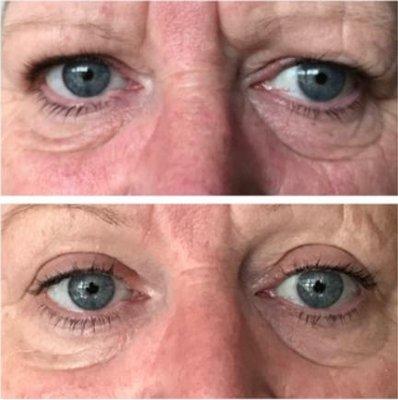 Plasma Pen No-Surgery Eyelift and Browlift