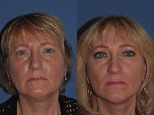 Brow / Facelift Before & After at Clinic of Facial Plastic Surgery | Buffalo, NY