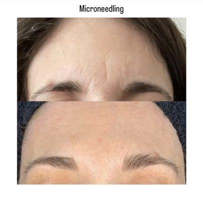 CIT Therapy that promotes collagen and elastin improving wrinkles, scarring, tightening pores and texture.