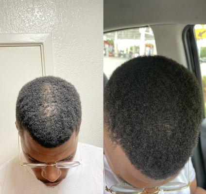 Customer's before and after photo of using our Herbal Hair Growth Oil. Real results in under 30 days