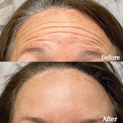 Say Goodbye to Forehead Wrinkles with Botox: Elevate Your Confidence and Beauty! ‍