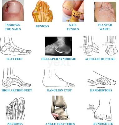 Common Foot Problems