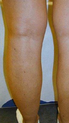 After varicose vein treatment.