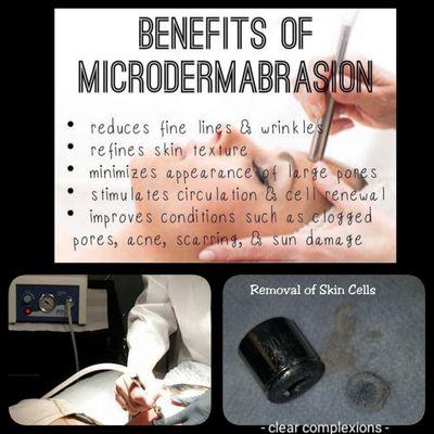 Results from a Microdermabrasion Facial