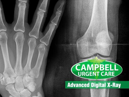 Digital XRay @ Campbell Urgent Care