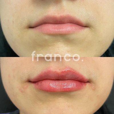 Natural Lip Filler Results