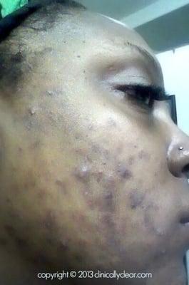 Nica B. "before" starting acne treatment at Clinically Clear