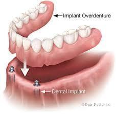 Implant Overdentures allow you to snap in dentures for a more secure and comfortable fit...