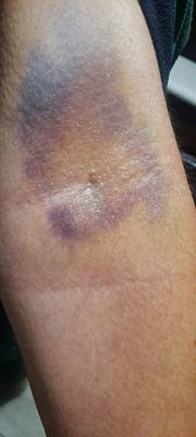 My injury 5 days after