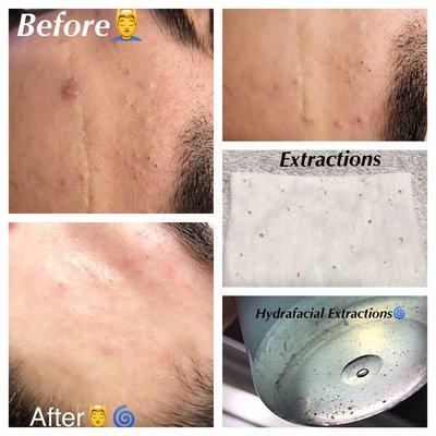 Hydrafacial with extra extractions