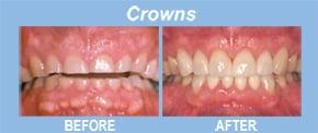 Crowns or "caps" are custom-fabricated to cover the whole tooth. They are appropriate for teeth that are worn, broken down, w...