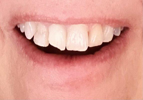 two upper teeth damaged in accidental fall