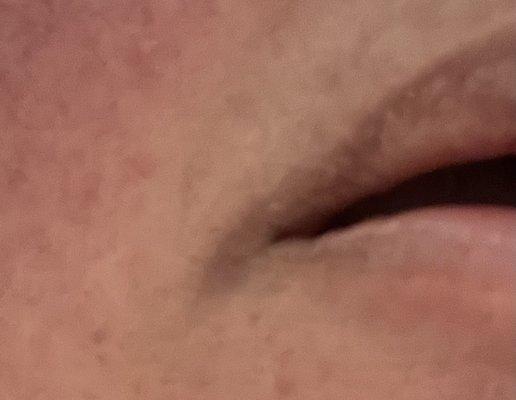 Hyperpigmentation from scaring the corner of my mouth. Slowly fading. I hope it goes away completely