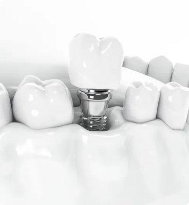 dental implants near me