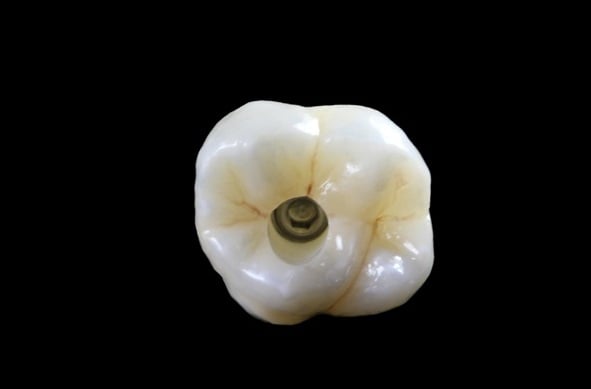 Screw-Retained Full Zirconia Implant