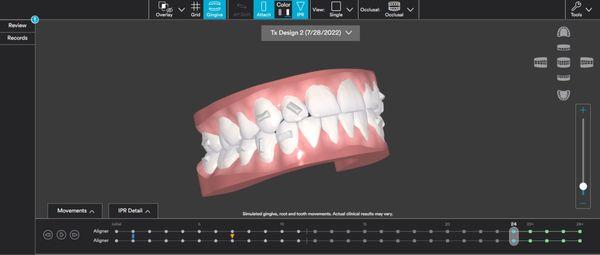 We use the latest technology to design your smile and bite to the very last detail.