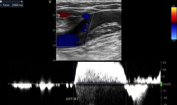 Venous insufficiency is a primary cause for leg swelling.