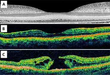 State of the art imaging for diagnosing and managing eye diseases