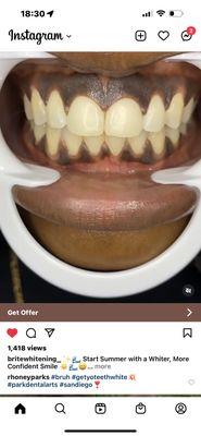 Gym guy's teeth.