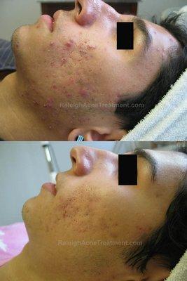 Acne Treatment results at Luminosity Acne Skincare.