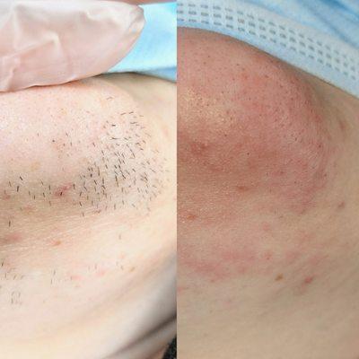 Before & After Very First Treatment (redness is completely normal)