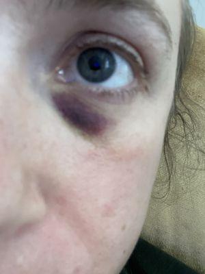 Bruising from Botox