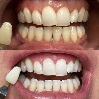 Cosmetic teeth whitening - Instant results!