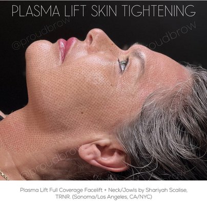 Full coverage facelift + neck/jowls Plasma lift skin tightening treatment